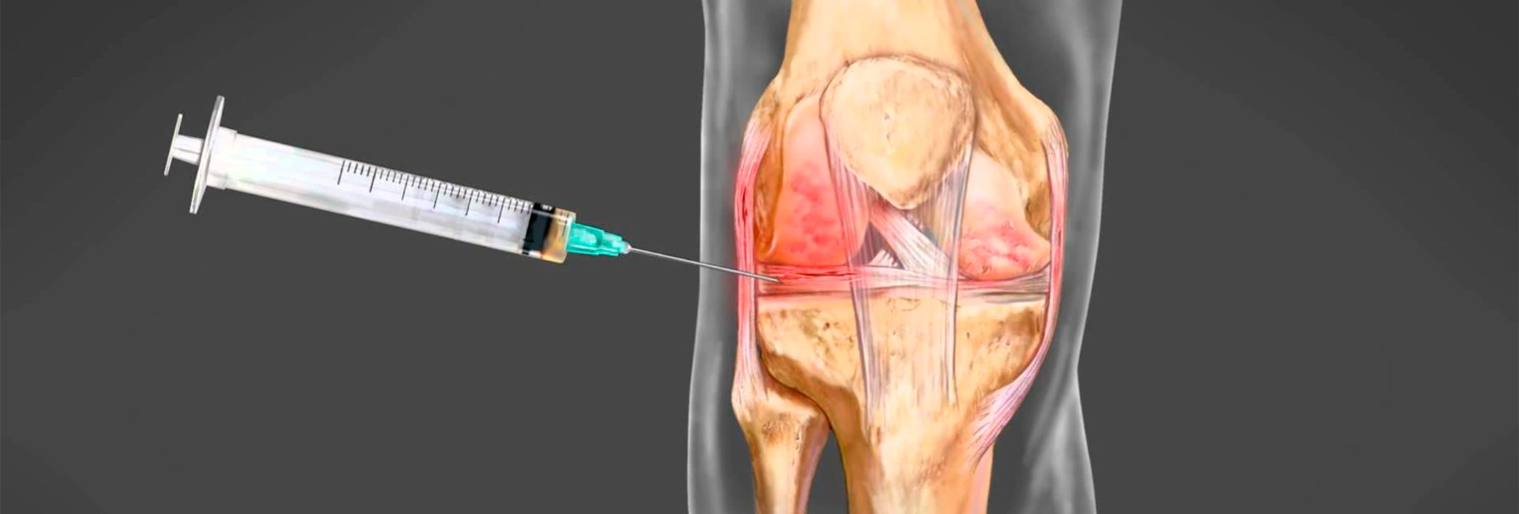 Пункция сустава — диагностика и лечение после травмы